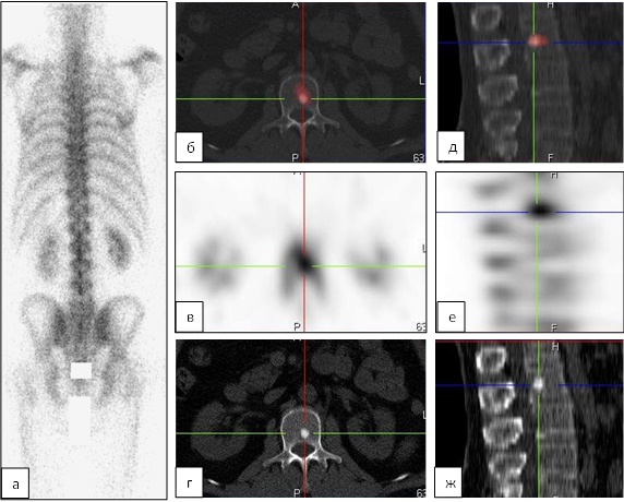 Гиперфиксация рфп что это такое. Сцинтиграфия скелета. Болезнь Педжета остеосцинтиграфия. Остеосцинтиграфия черепа. Болезнь Педжета сцинтиграфия.