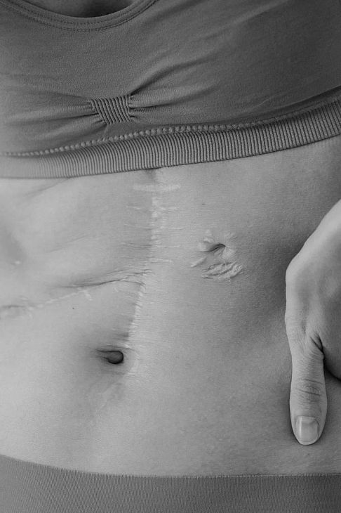 Откровенно о боли и силе: как пациентка Блохина победила рак IV стадии и сделала об этом выставку